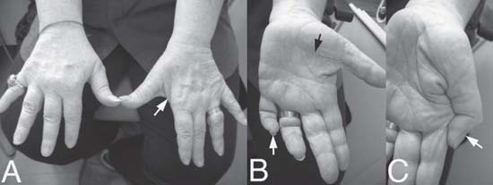 105 Ulnar Nerve Compression at the Elbow | Neupsy Key