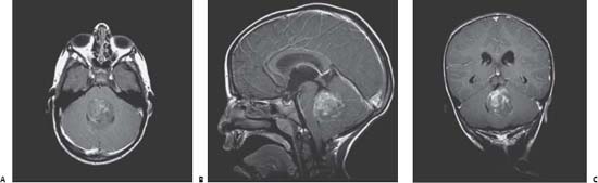 57 Cerebellar Medulloblastoma Neupsy Key 9387