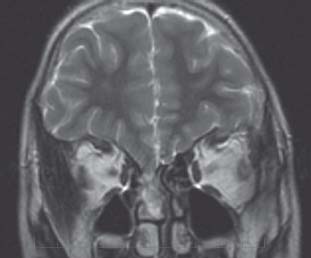 69 Spontaneous Cerebrospinal Fistula | Neupsy Key