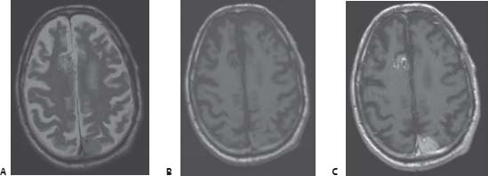 78 Stereotactic Radiosurgery Case | Neupsy Key