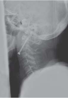 type 2 odontoid fracture x ray