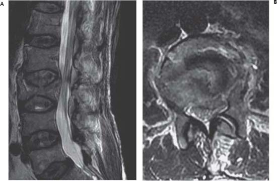 86 Lumbar Burst Fracture | Neupsy Key