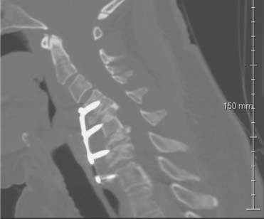 87 Cervical Spondylotic Myelopathy | Neupsy Key