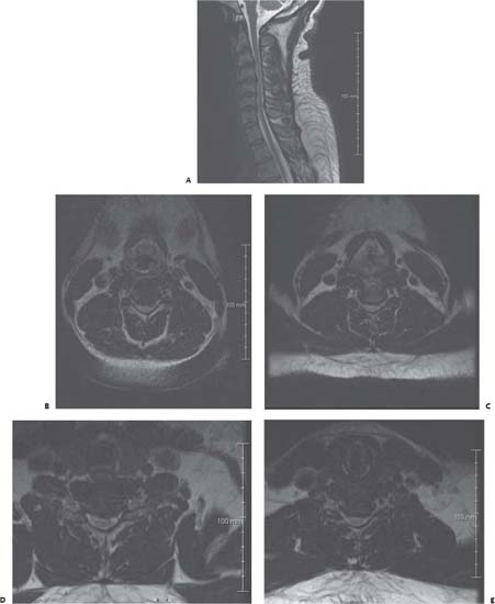 88 Anterior Versus Posterior Approach To The Cervical Spine Neupsy Key 3112