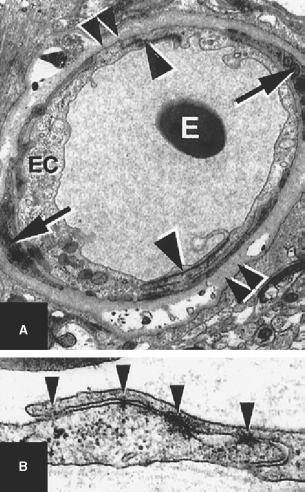 Molecular Biology of Cerebral Cavernous Malformations | Neupsy Key