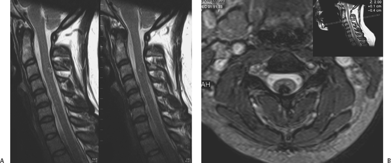 Cavernous Malformations of the Spinal Cord | Neupsy Key