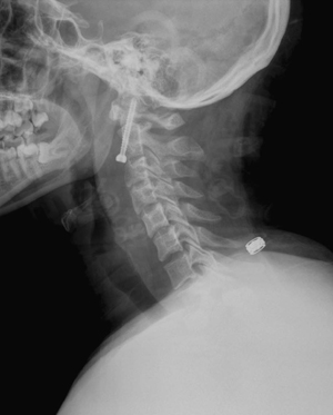 comminuted odontoid fracture type 1