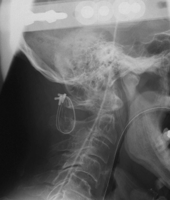 type 2 odontoid fracture x ray