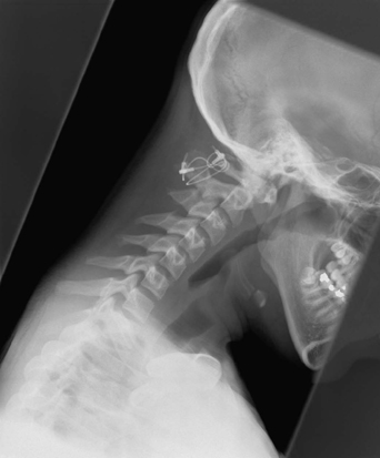 instability atlantoaxial flexion adi cervical ray widening demonstrates figure