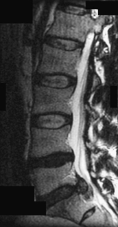 Large Disc Herniation Treated Percutaneously | Neupsy Key