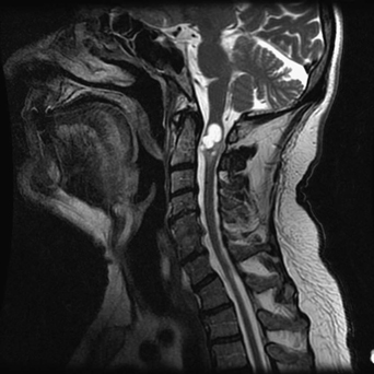 Intramedullary Lesions Multiple Neupsy Key