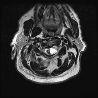 Intramedullary Lesions Multiple Neupsy Key