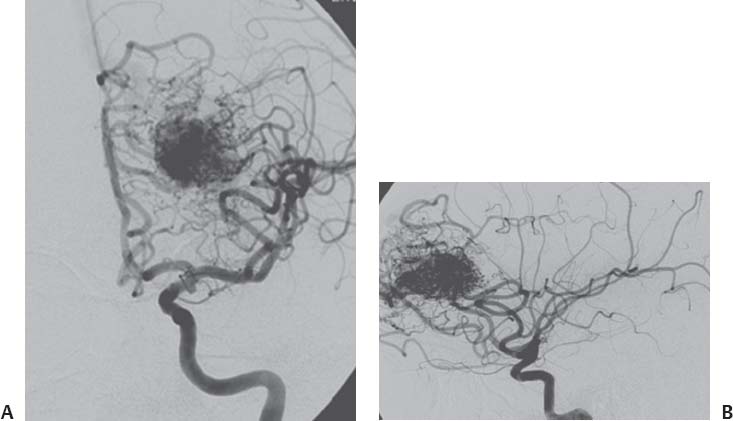 9: CEREBROVASCULAR DISEASE | Neupsy Key