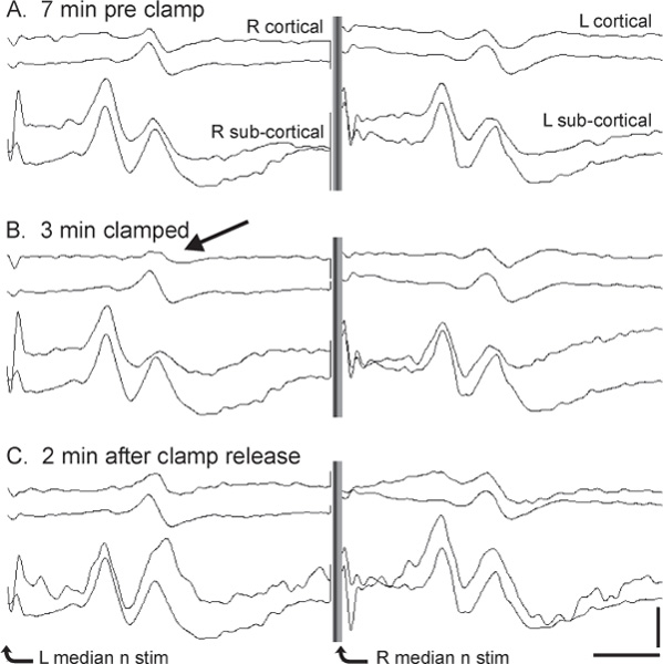 Intraoperative Neurophysiological Monitoring | Neupsy Key