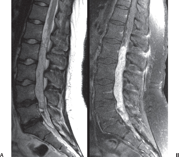 Spinal Tumors | Neupsy Key