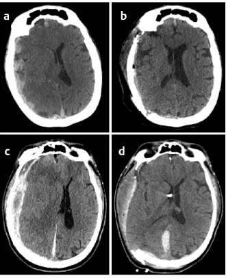 Risk of Anticoagulants and Antiplatelet Agents in Trauma Patients ...