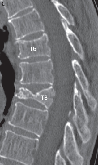 t8 compression fracture