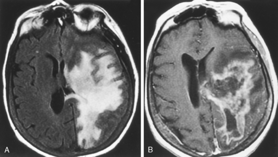 White Matter Diseases Neupsy Key