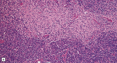 Embryonal neuroepithelial neoplasms of the CNS | Neupsy Key