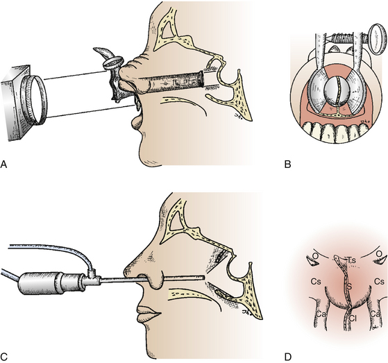 Endoscopic Endonasal Pituitary And Skull Base Surgery Neupsy Key 