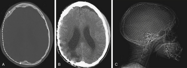 Management Of Pediatric Severe Traumatic Brain Injury | Neupsy Key