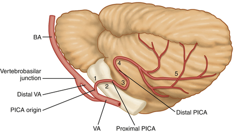Posterior Inferior Cerebellar Artery Aneurysm