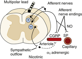 Spinal Cord Stimulation For Chronic Pain | Neupsy Key