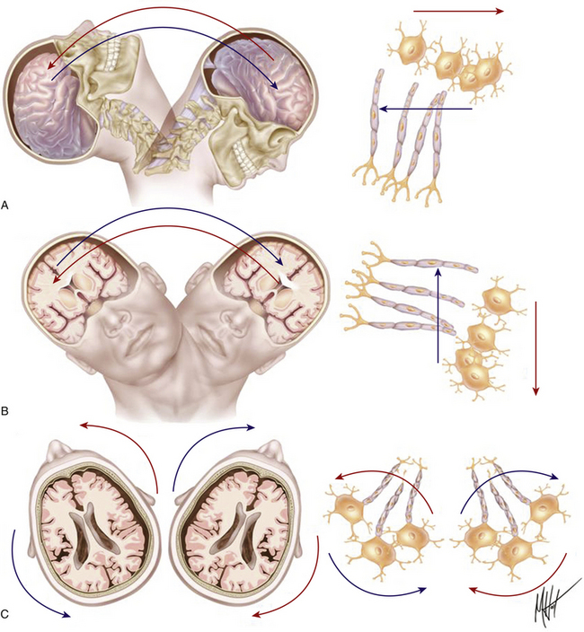 surgical-management-of-severe-closed-head-injury-in-adults-neupsy-key