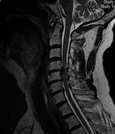 Circumferential Cervical Spinal Fusion | Neupsy Key