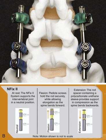 Dynamic Stabilization of the Lumbar Spine: Indications and Techniques ...