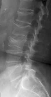 Vertebroplasty and Kyphoplasty: Indications and Techniques | Neupsy Key