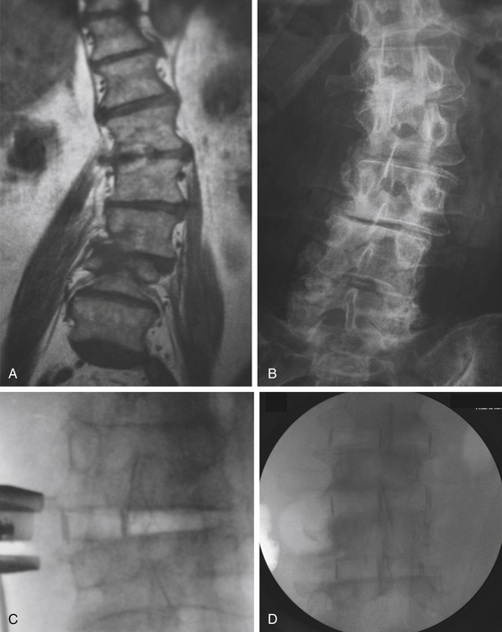 Management Of Degenerative Scoliosis | Neupsy Key