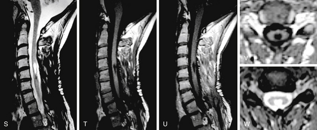 Surgical Management Of Intramedullary Spinal Cord Tumors Neurosurgery