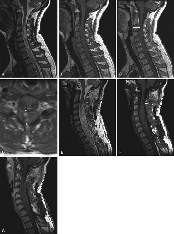 Surgical Management Of Intramedullary Spinal Cord Tumors Neurosurgery