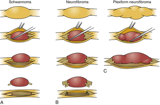 peripheral-nerve-tumors-of-the-extremities-neupsy-key