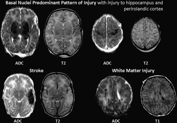 Hypoxic and anoxic brain injury
