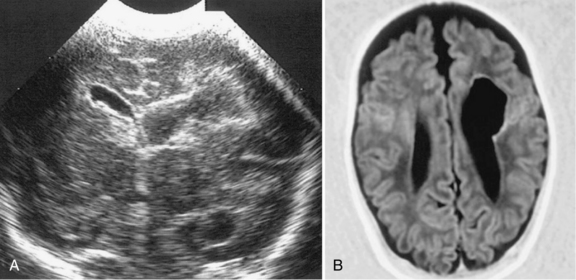 Injury To The Developing Preterm Brain Intraventricular Hemorrhage And