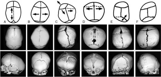 Congenital Anomalies Of The Skull Neupsy Key 3276