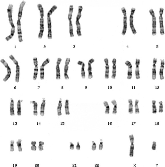 Ring chromosome 13 syndrome