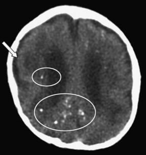 Viral Infections of the Nervous System | Neupsy Key