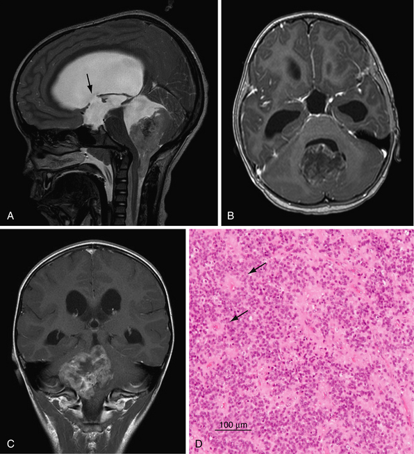 Posterior Fossa and Brainstem Tumors in Children | Neupsy Key