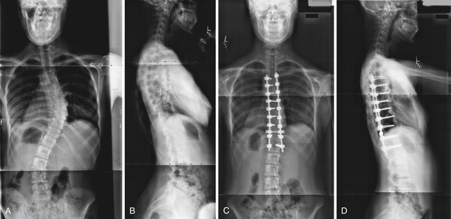 Pediatric And Adult Scoliosis | Neupsy Key