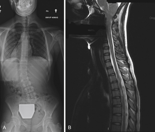 Pediatric and Adult Scoliosis | Neupsy Key