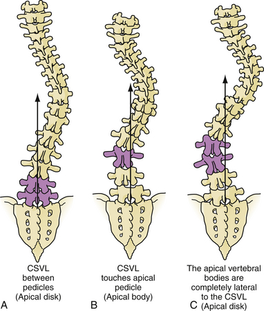 Pediatric And Adult Scoliosis | Neupsy Key