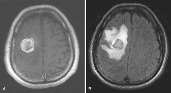 Metastatic Brain Tumors | Neupsy Key