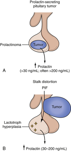 Pituitary Tumors Diagnosis And Management Neupsy Key 