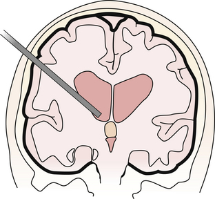 Endoscopic Approaches to Ventricular Tumors and Colloid Cysts | Neupsy Key