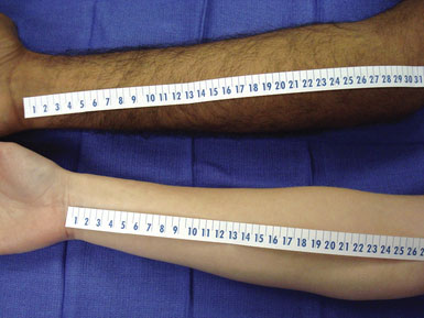 Radial Artery Harvest for Cerebral Revascularization: Technical Pearls ...