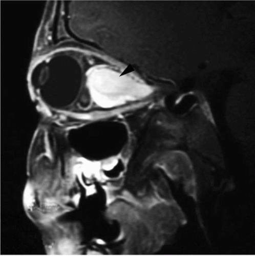 neurofibromatosis type 1 mri