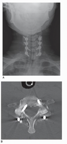 Controversies In Cervical Bone Grafting | Neupsy Key